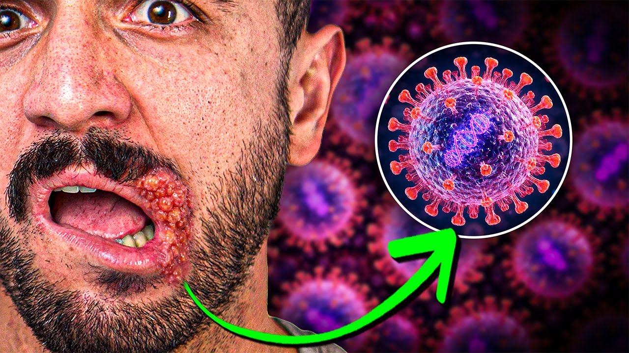 Herpes genital: síntomas, tratamiento y convivencia