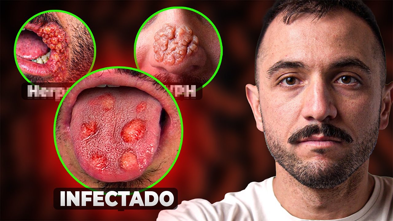 Infecciones sexuales: lo que todo hombre debe saber