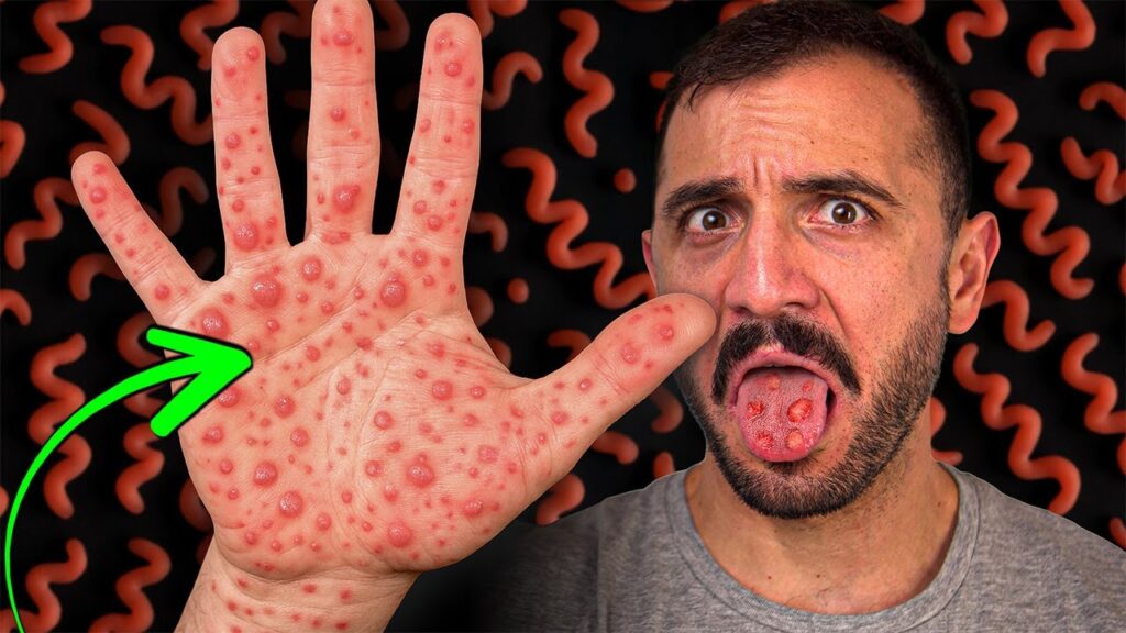 Sífilis: síntomas, contagio y tratamiento actual