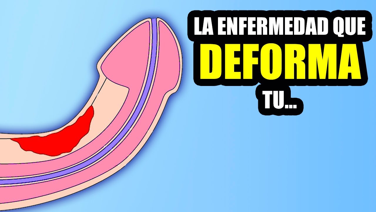 Enfermedad de Peyronie: la curvatura del pene que pocos conocen