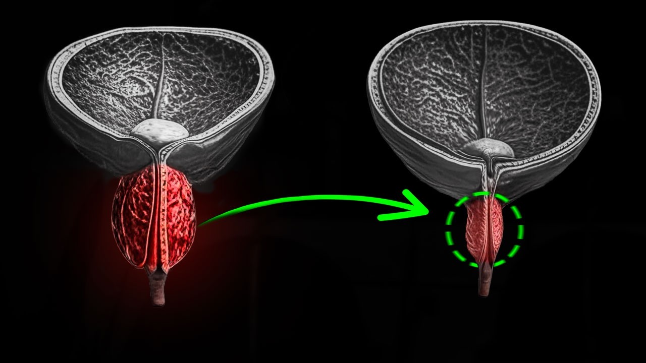 Hiperplasia Prostática Benigna: Cómo Reducir la Próstata